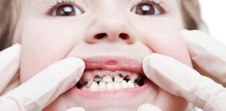 Çocuk diş doktoru (pedodontist) nedir ve ne iş yapar? Diş çürükleri